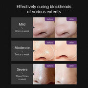 ABR - Blackhead Remover